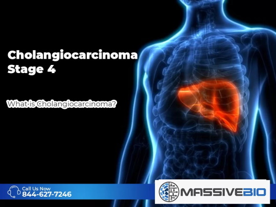 Cholangiocarcinoma Stage 4