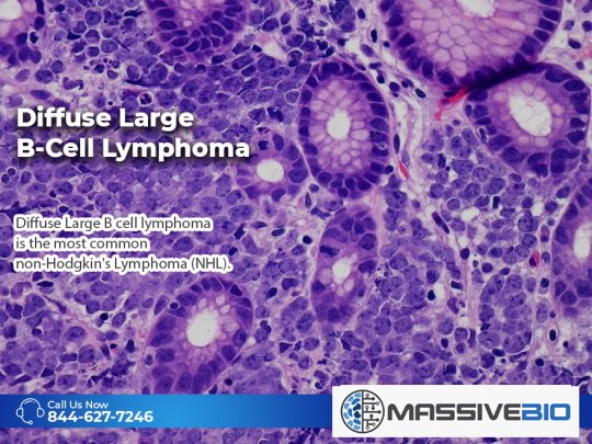Diffuse Large B-Cell Lymphoma
