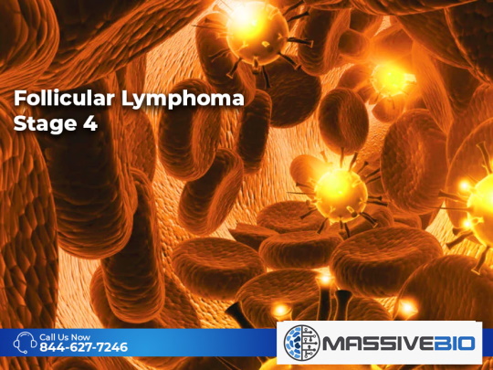 follicular lymphoma stage 4 02