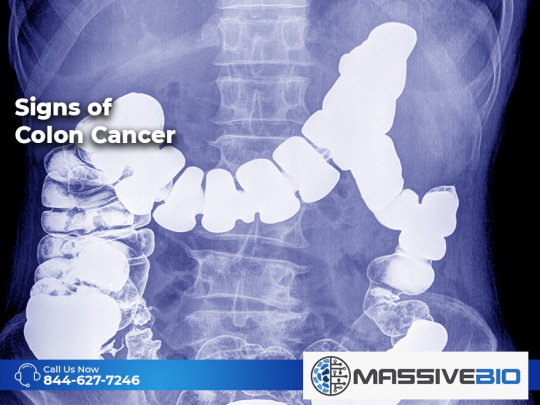 signs of colon cancer 01