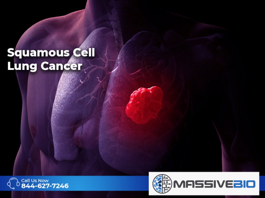 squamous cell lung cancer 02