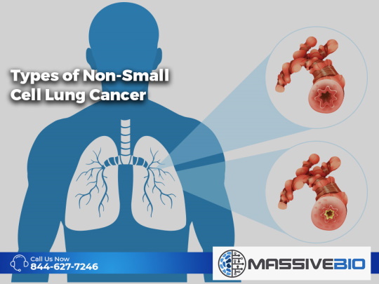 types of non small cell lung cancer 01