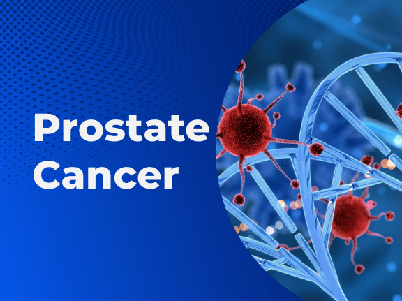 Prostate Cancer 01
