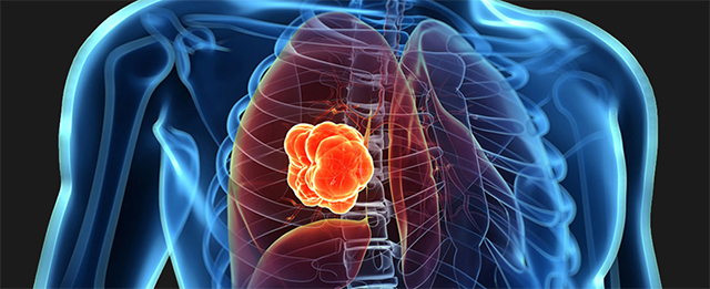 Lung Cancer Clinical Trials