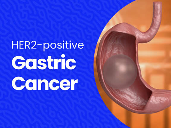 Gastric Cancer Her2 Positive 1