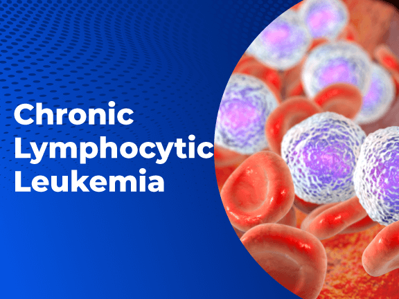 Chronic Lymphocytic Leukemia 01