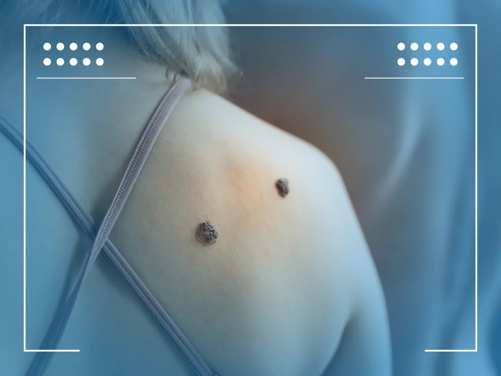 cancer de pele melanoma 01