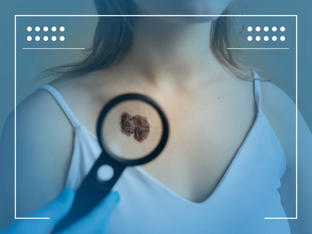 carcinoma basocelular 01