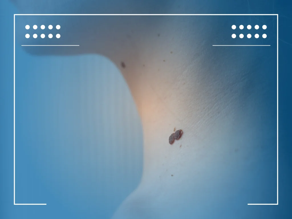 carcinoma basocelular nodular 001