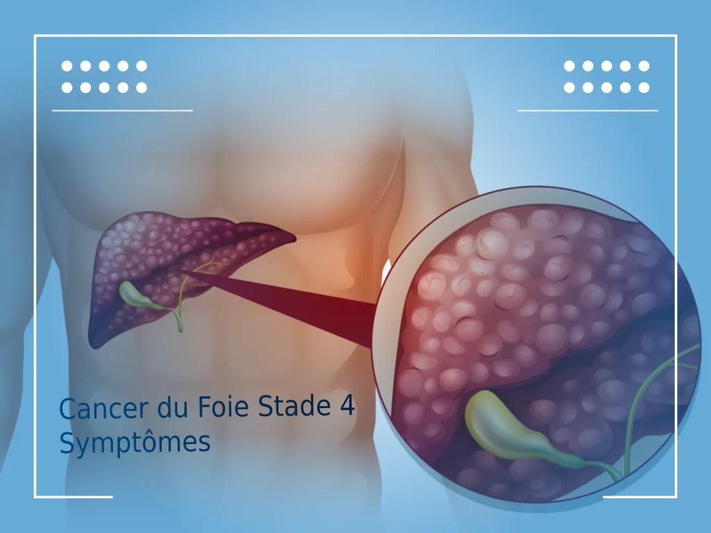 cancer du foie stade 4 symptomes 001 1
