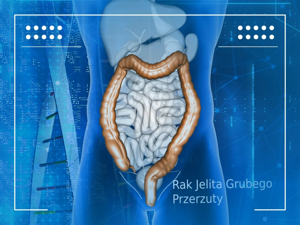 rak jelita grubego przerzuty 001